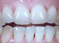 Saubere, gereinigte Zähne